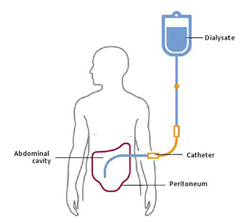 Peritoneal Dialysis