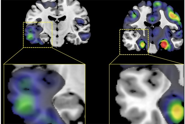 Atrophy in lateral temporal lobe (left) of participant in AD-Language subgroup; atrophy in medial temporal lobe (right) of participant in AD-Memory subgroup. Source: Alzheimer’s & Dementia journal. 