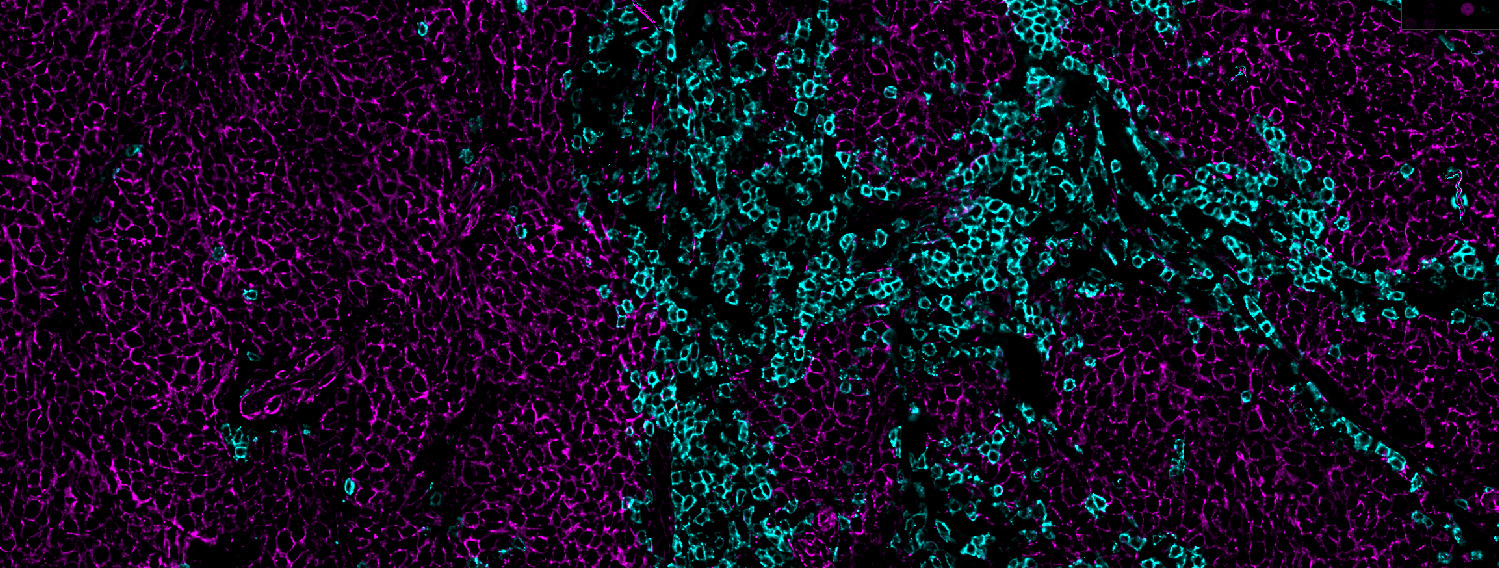 Immune checkpoint inhibitors help release molecular brakes that allow cancer-killing immune cells (cyan) fight Merkel cell carcinoma (magenta). But to wage an effective seige against an MCC tumor, immune cells need fresh reinforcements. Fred Hutch and UW Medicine studies show that it's the presence of these reinforcements in a patient's blood that best predict whether checkpoint inhibitors will work for them. Image courtesy of Kimberly Smythe and Kristin Robinson / Fred Hutch Translational Pathology