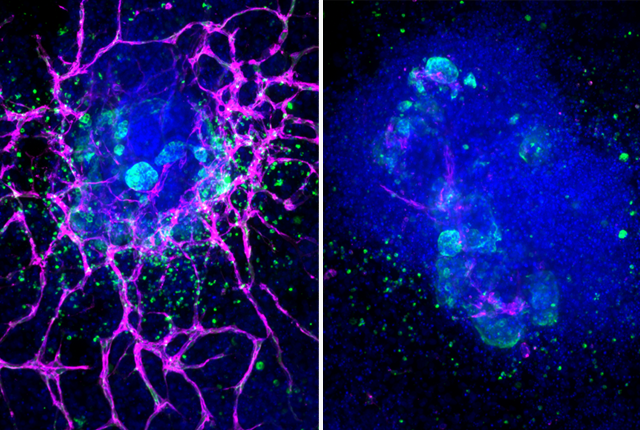 A healthy kidney organoid (left) extends a network of blood vessel cells (pink), but such cells disappear after treatment with interferon (right). Image courtesy Benjamin Freedman.