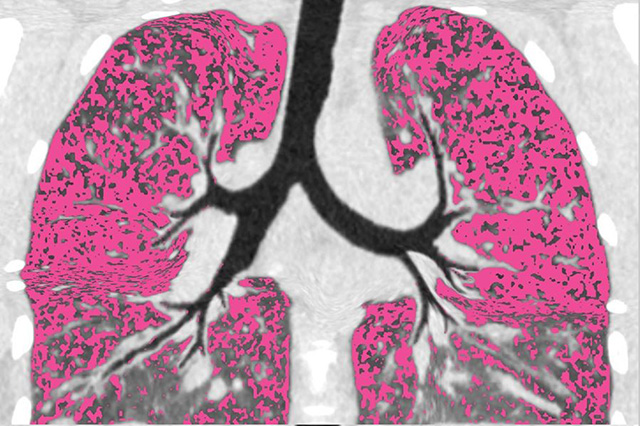 Air trapping (colored pink) in lungs of a cystic fibrosis patient before CFTR modulator treatment. Image: R. Villacreses & D. Stolz, University of Iowa