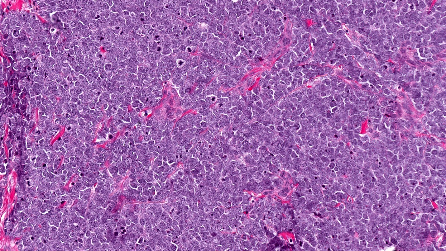 Merkel Cell Carcinoma cells