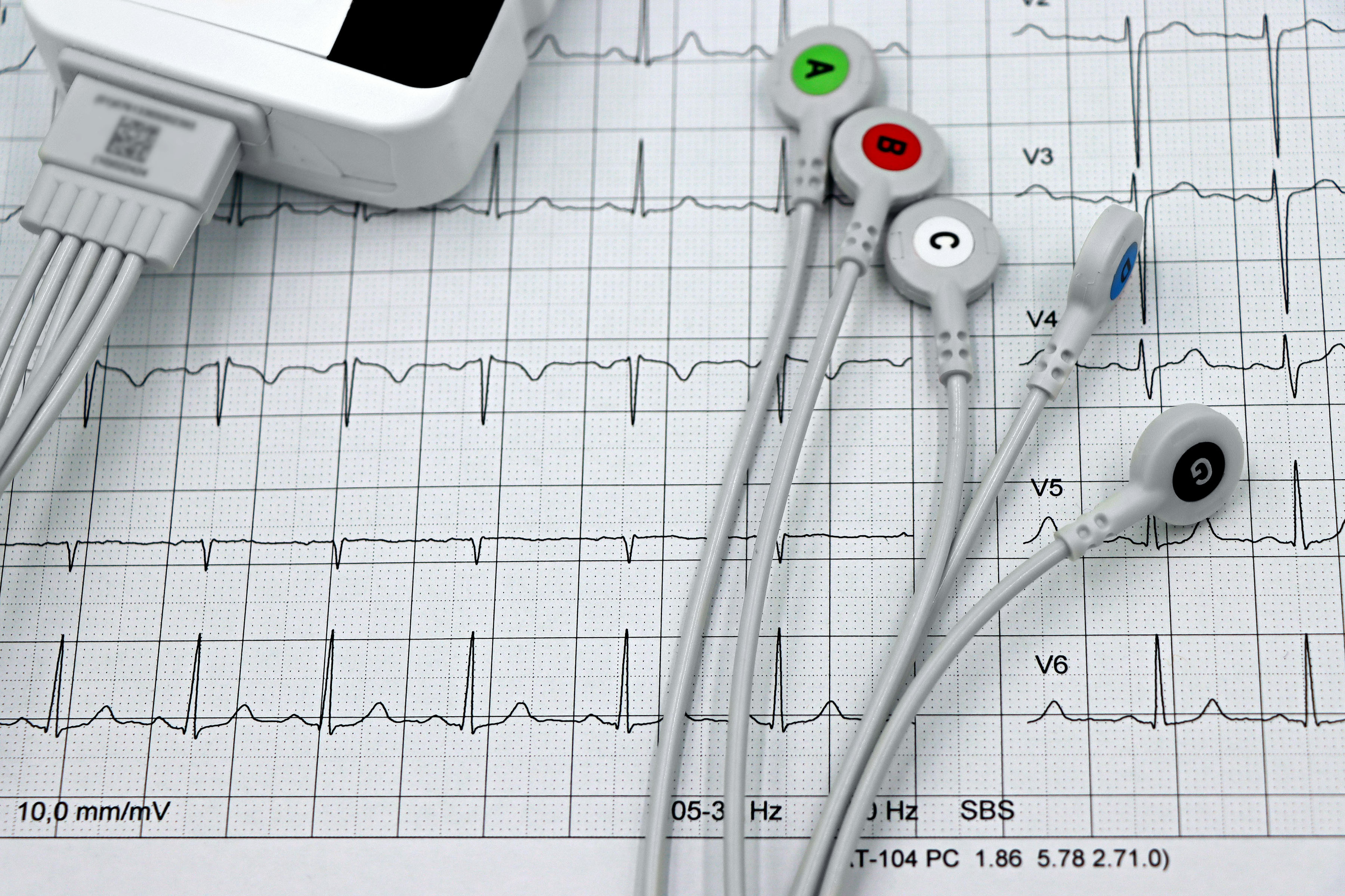 Close-up of ECG monitor leads on a printed cardiogram, showcasing heart health diagnostics. Image: Pexels.