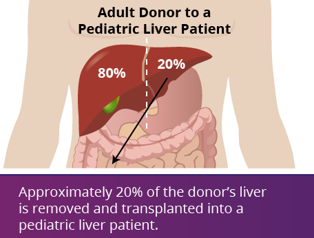 Adult donor to a pediatric liver patient graphic. Courtesy UW Medicine.