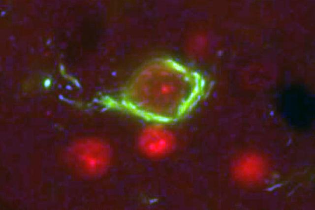 Defective tau proteins form insoluble neurofibrillary tangles (green) that cause neurons to die. Image: Kraemer Lab.