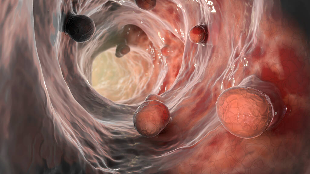 Colorectal polyp