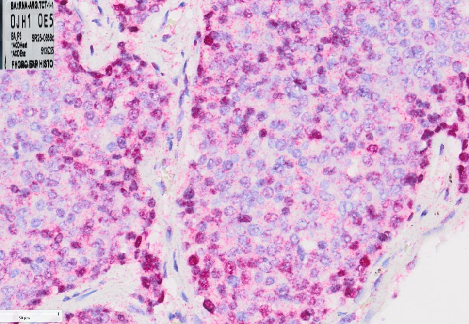 Low amounts of a specific tRNA in prostate tumors were associated with the tumor being less androgen receptor dependent and therefore less likely to respond to androgen receptor targeting therapies. Credit: Dr. Yeon Soo Kim, Hsieh Lab, Fred Hutch Cancer Center
