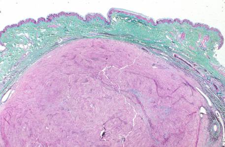 Cellular Scwannoma trichrome